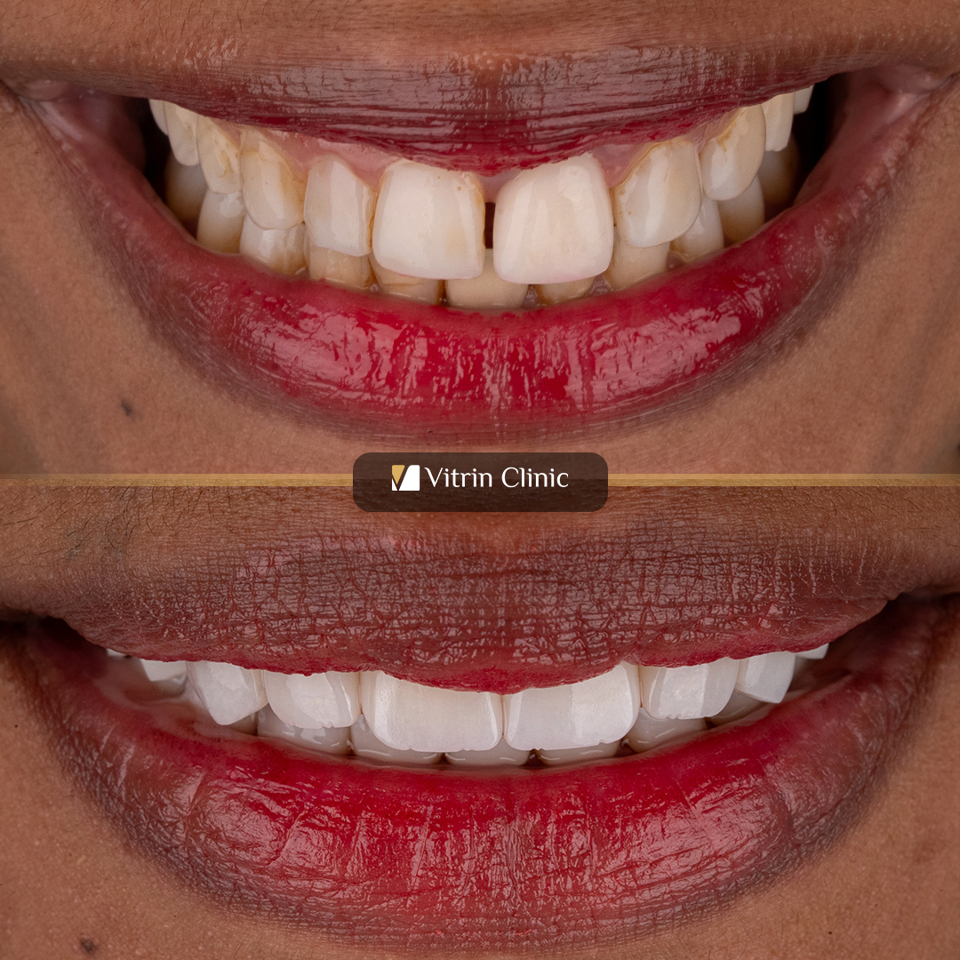 Full Mouth Dental Crowns in Turkey: Cost, Materials, Process & Results